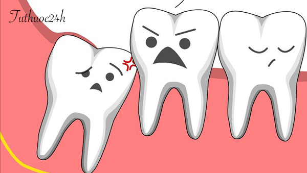 Những dấu hiệu đau răng khôn bạn cần phát hiện sớm để giảm cơn đau