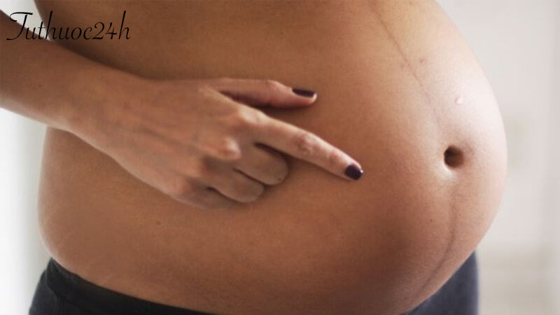 Giải đáp một số thắc mắc liên quan đến đường lông bụng khi mang thai