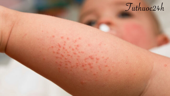 Bệnh chàm ở trẻ em có những dấu hiệu nào? Có nguy hiểm không?