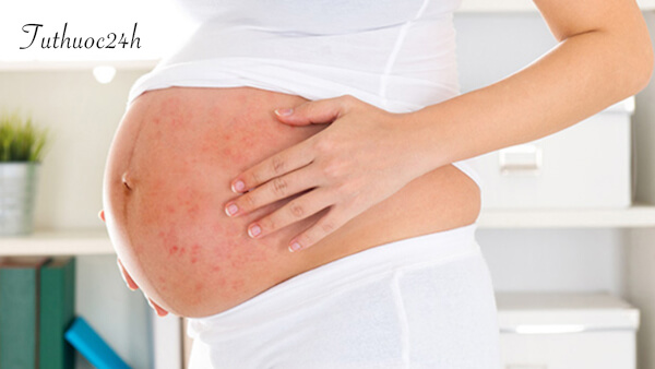 Phụ nữ bị thuỷ đậu khi mang thai ảnh hưởng gì đến thai nhi?