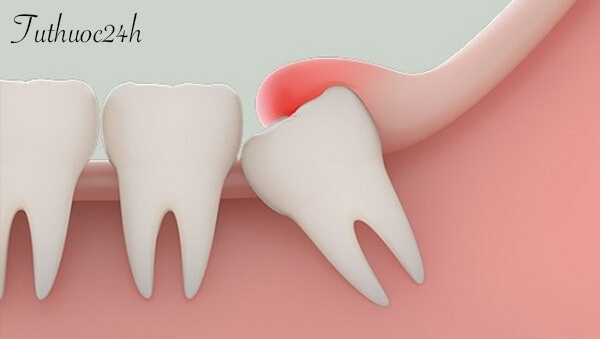 Răng khôn mọc lệch có nguy hiểm không? Có nên nhổ răng khôn