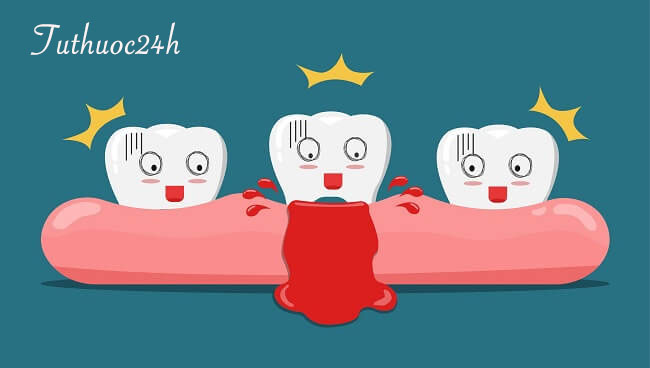 Chảy máu chân răng – dấu hiệu cảnh báo mắc bệnh răng miệng nghiêm trọng