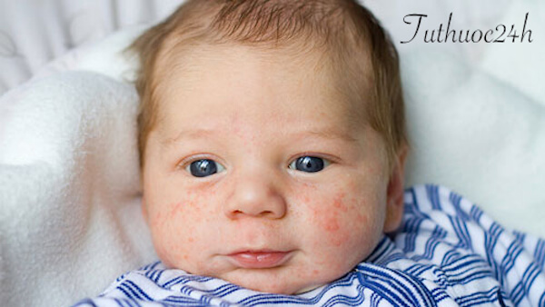 Trẻ sơ sinh bị nẻ mặt và cách chữa trị mẹ cần chú ý