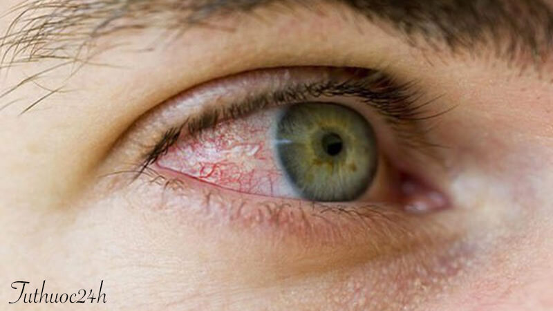 Viêm kết mạc mắt có nguy hiểm không? Cùng tìm câu trả lời nào