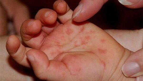 Những điều NÊN và KHÔNG NÊN khi bé mắc bệnh tay chân miệng mà bố mẹ cần biết