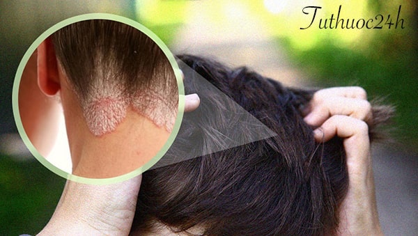 Bệnh á sừng da đầu có dấu hiệu gì? Đâu là cách chữa hiệu quả?