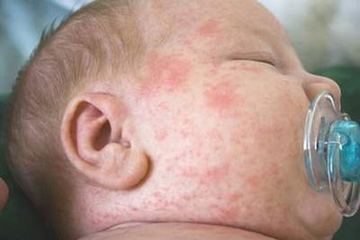 Bệnh chàm xuất hiện nhiều ở trẻ sơ sinh