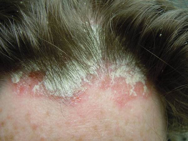 biểu hiện của bệnh nấm da đầu
