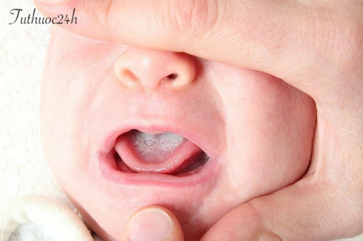 Bệnh nấm lưỡi ở trẻ thường xuất hiện ở trẻ sơ sinh đến 9 - 10 tuổi