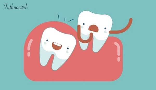 Biến chứng răng khôn thường có nguy hiểm không? Có nên nhổ không?
