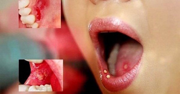 Chẩn đoán nhiệt miệng thông qua các vết loét