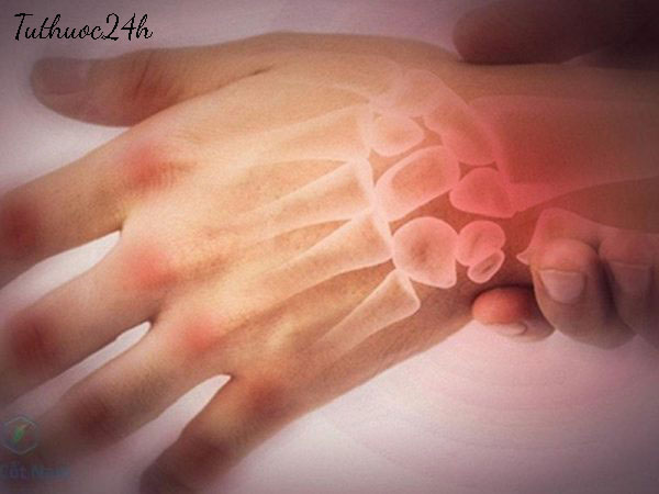 cách chữa viêm khớp cổ tay
