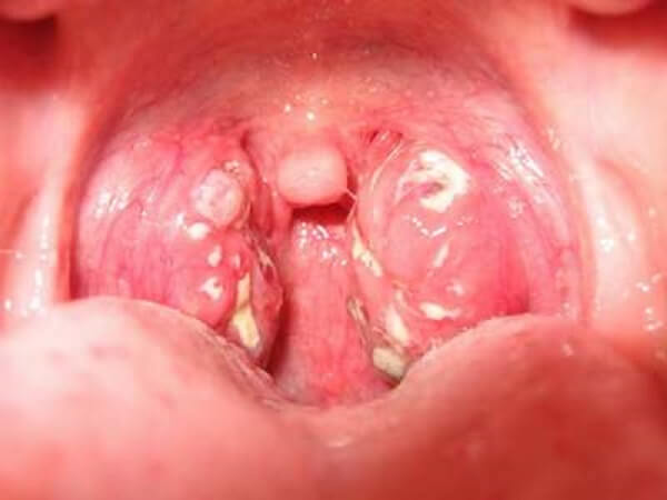 triệu chứng bệnh ung thư vòm họng