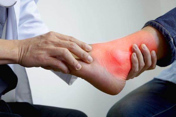 Chẩn đoán bong gân cổ chân qua các triệu chứng