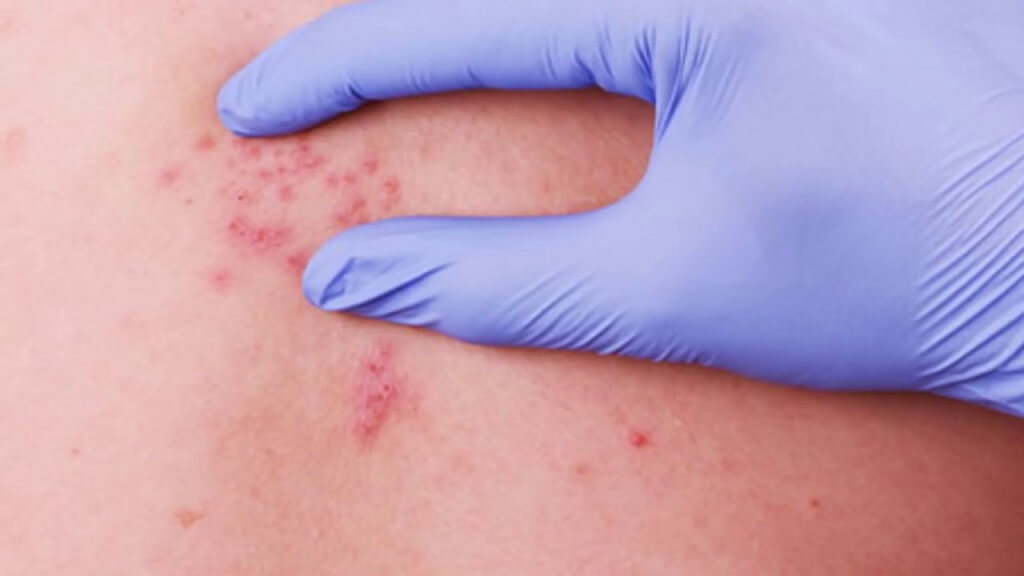 Để ngăn chặn sự phát triển của bệnh, tránh tiếp xúc da với da người chưa từng bị thủy đậu