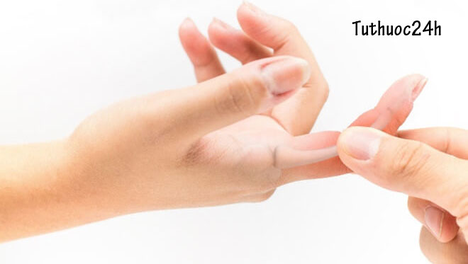 Viêm khớp ngón tay  và cách chữa trị hiệu quả
