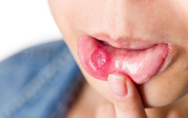 Nguyên nhân gây nhiệt miệng có thể xuất phát từ thiếu vitamin 
