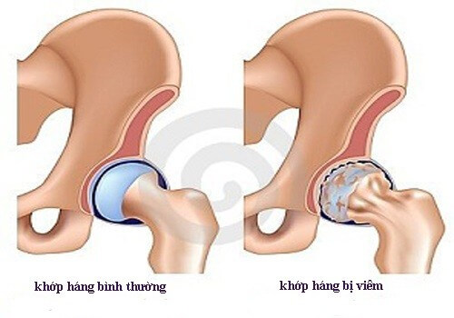 Bệnh viêm khớp háng là căn bệnh không quá nguy hiểm, nhưng ảnh hưởng nghiêm trọng đến vận động