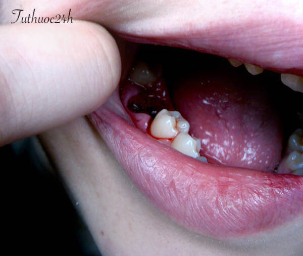 Hình ảnh minh hoạ lỗ sau khi nhổ răng