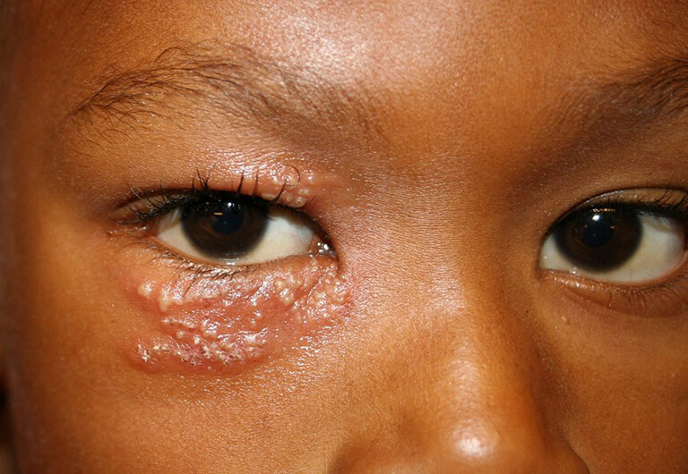 Bệnh zona thần kinh ở mắt  còn có tên gọi khac slaf giời leo, đây là căn bệnh nguy hiểm