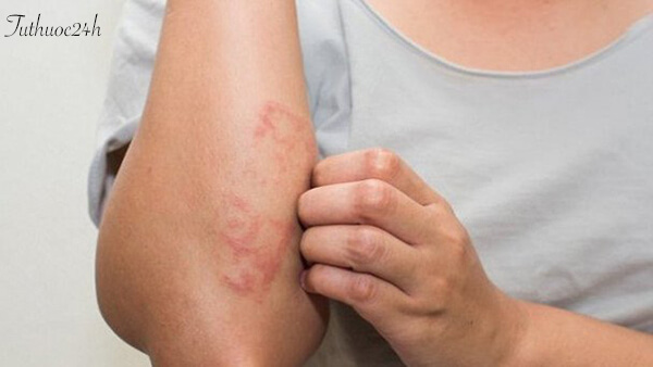 Các vết mẩn đỏ thường xuất hiện ở khắp cơ thể