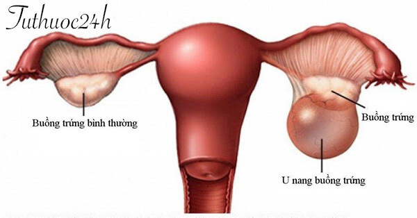 U nang buồng trứng là khối dịch bất thường nằm trong buồng trứng