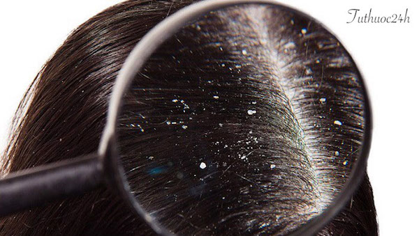 Bệnh nấm da đầu là gì? Nguyên nhân và biểu hiện bệnh nấm da đầu