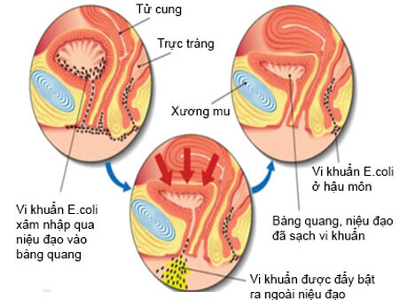 E.coli chính là nguyên nhân đầu tiên gây nên bệnh viêm đường tiết niệu