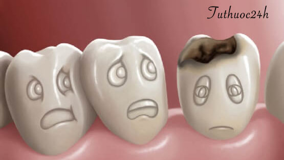 7 cách chữa sâu răng tại nhà cực kì đơn giản