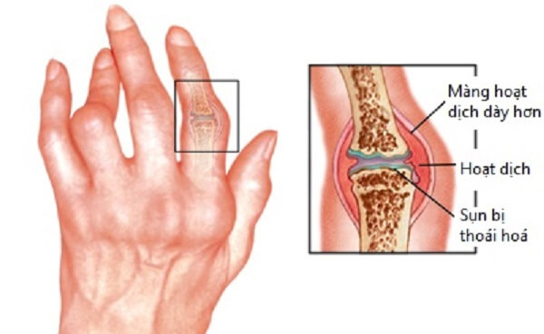 nguyên nhân gây nên bệnh viêm khớp ngón tay là có thể do cả yếu tố nội lực và ngoại lực