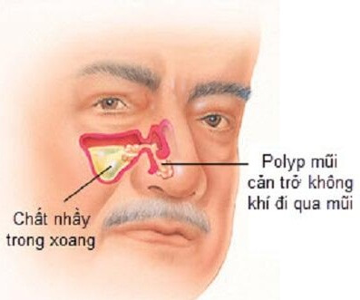 Poly mũi phát triển gây nên tình trạng suy giảm miễn dịch, bệnh viêm xoang mãn tính xuất hiện