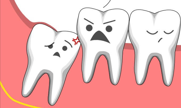răng khôn là răng mọc cuối hàm, thườn mọc trong tuổi 17- 25