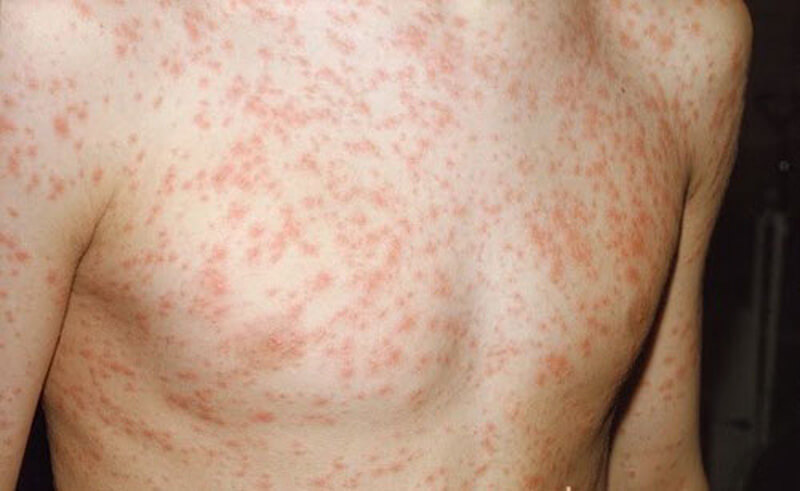 Sốt phát ban là triệu chứng nóng sốt, da nổi các đốm đỏ