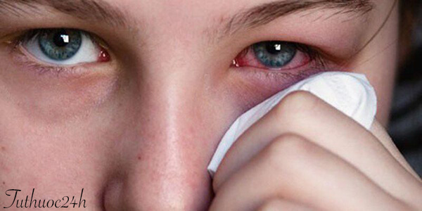 Đỏ mắt là triệu chứng đặc trưng của bệnh viêm kết mạc mắt