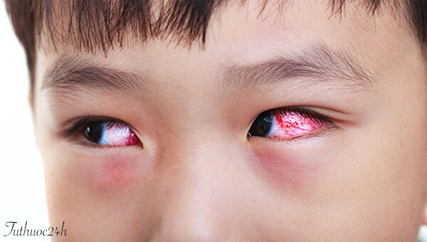 Khi bị dị ứng mắt, mắt trẻ sẽ đỏ, chảy nước mắt và tiết dịch nhầy