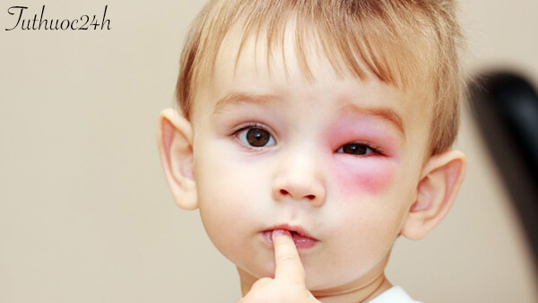 Nguyên nhân gây sưng mí mắt ở trẻ em - Cách phòng tránh và điều trị