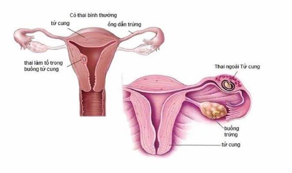Hình ảnh minh hoạ thai ngoài tử cung