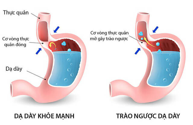 thế nào là trào ngược dạ dày?