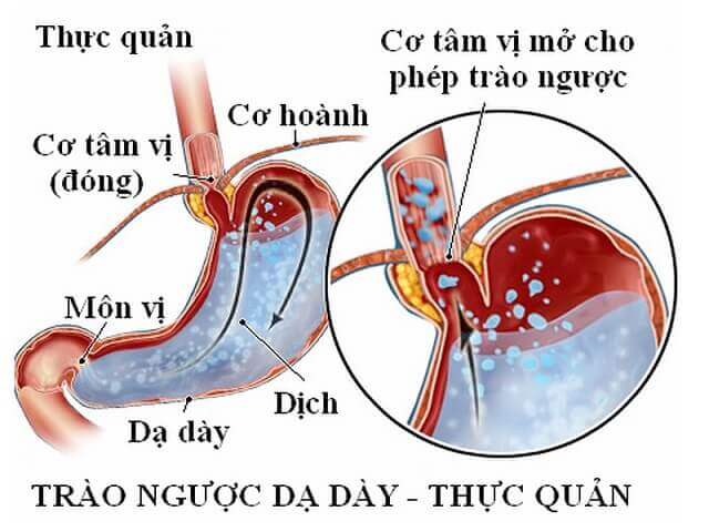 Hình ảnh về trào ngược dạ dày