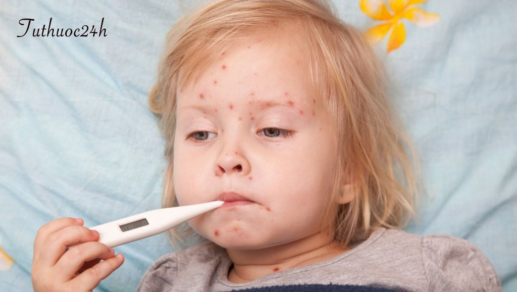 Trẻ bị sốt phát ban nên ăn gì và kiêng gì để nhanh khỏi bệnh?