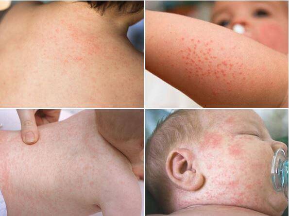 Trẻ sốt phát ban thường có những biểu hiện như xuất hiện các mẩn đỏ ở nhiều vùng da
