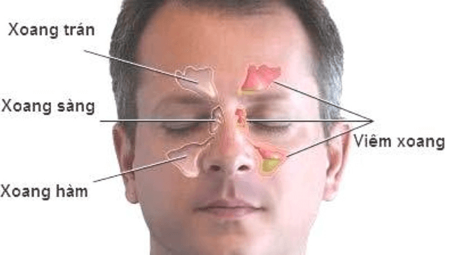 Viêm xoang sàng làm bệnh phổ biến, gây cảm giác khó chịu ở giữa hai mắt, trên hốc mũi